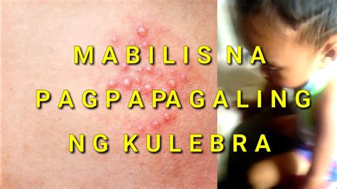 kulibrang apoy in english|Kulebra (Tagalog) « Globale Dermatologie.